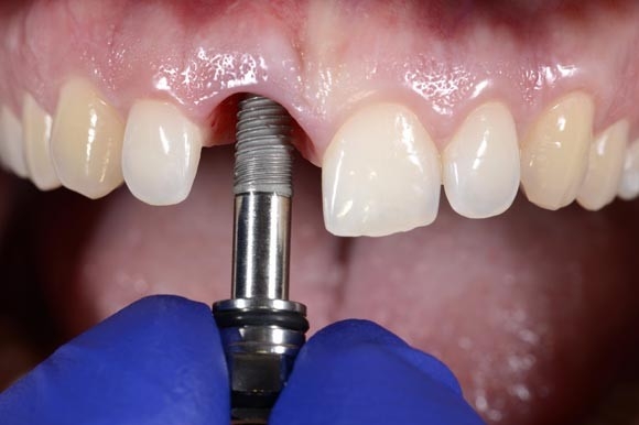 Colocación de implante dental en procedimiento clínico