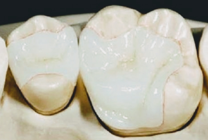 Restauración dental de alta precisión