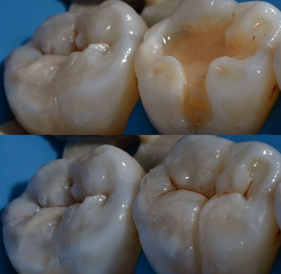 Trabajo de restauración dental